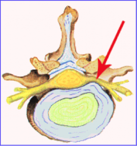 Diferencias entre hernia discal y protusión