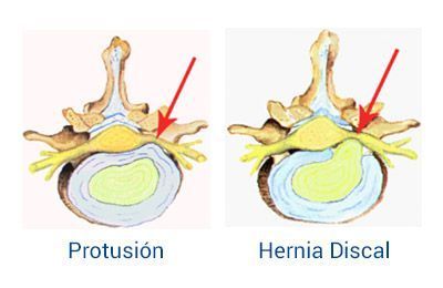 Hernia Discal o Protusión - Fisiolution