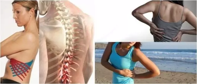 neuralgia intercostal 1
