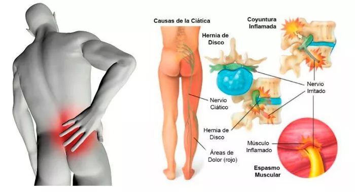 Ciática 5 ejercicios