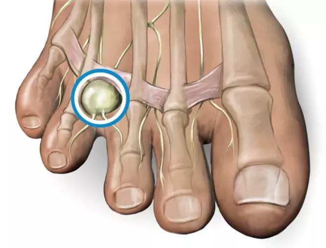mortons-neuroma