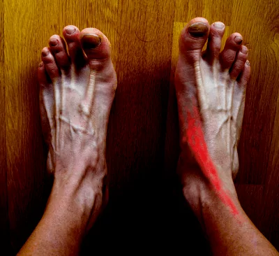 dolor por tendiditis del tibial anterior