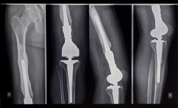 radiografia operacion gonartrosis