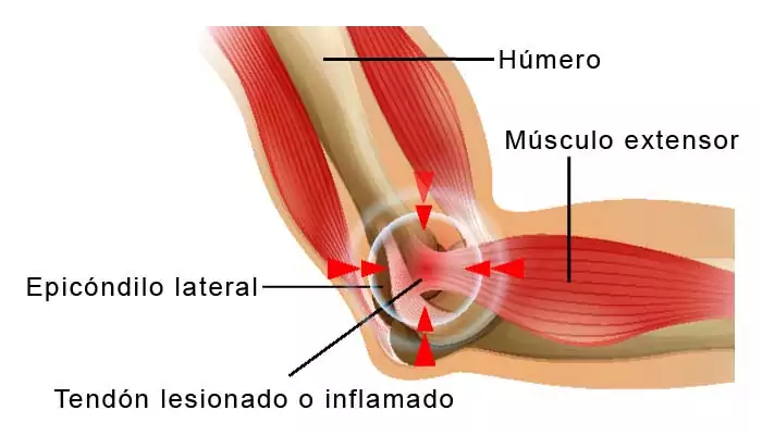 codo de tenista tendiditis
