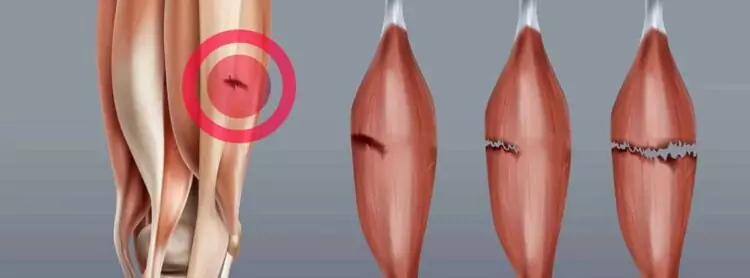 microrotura fibrilar del gemelo causas